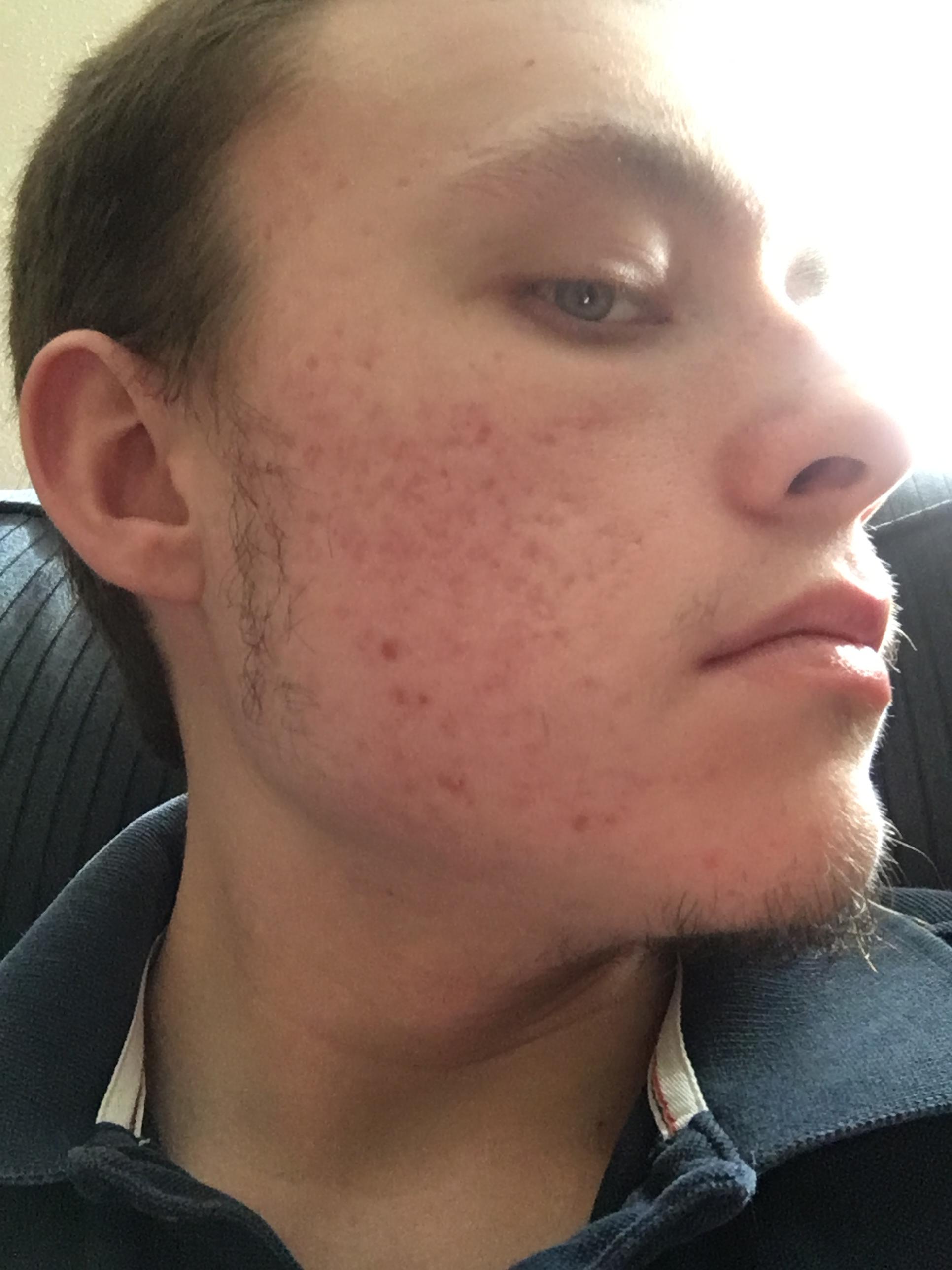 How to treat red acne marks / Pih Hyperpigmentation red/dark marks Forum