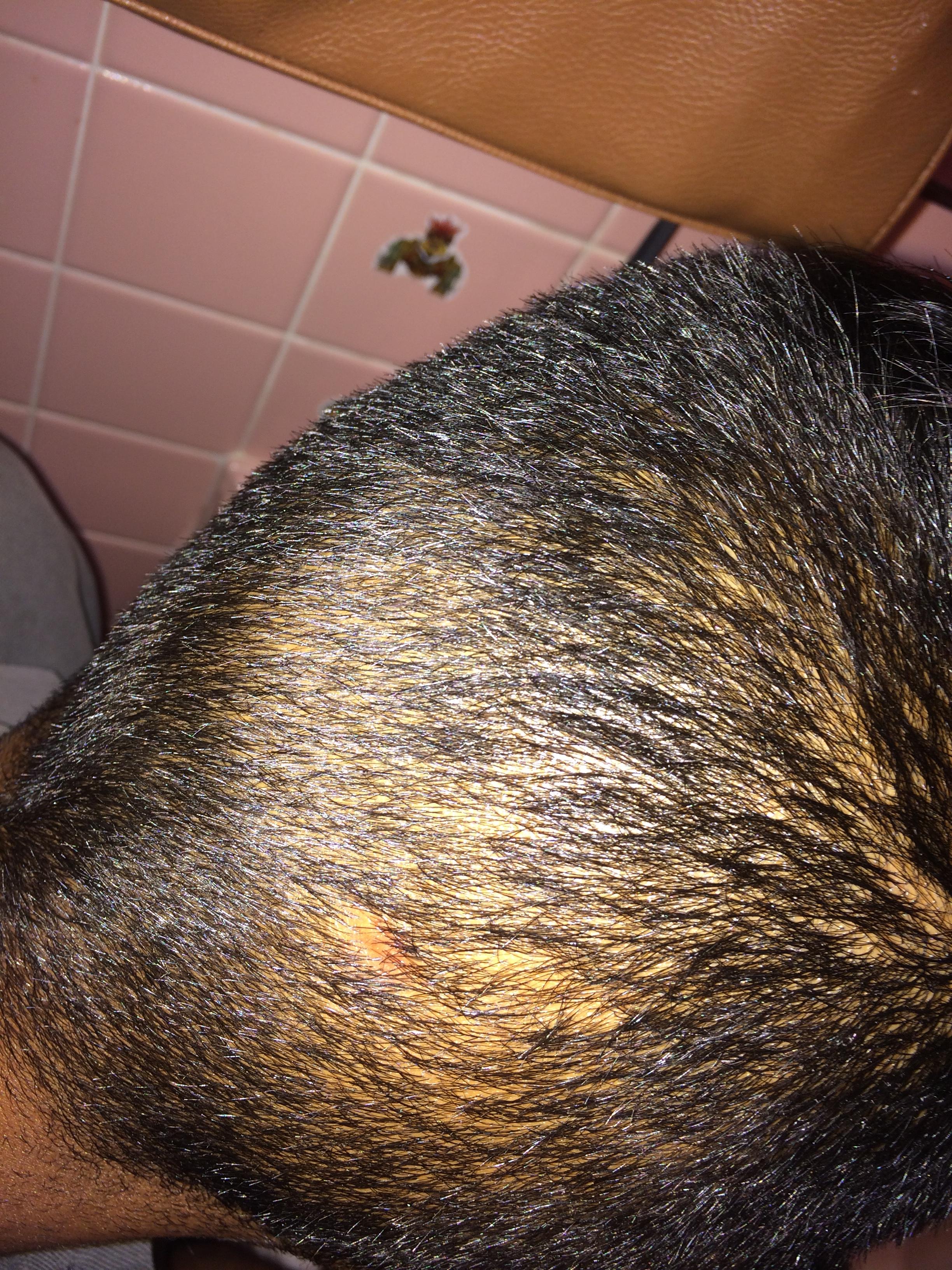 Bald spot on head after cyst General acne discussion Bald spot on head after cyst General acne discussion