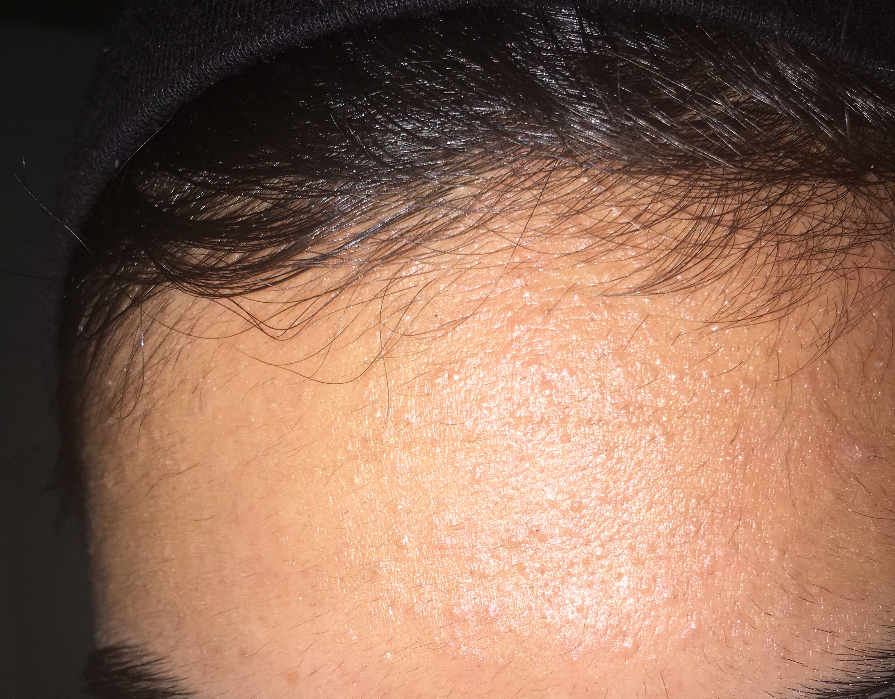 is this acne or Pityrosporum Folliculitis? General acne