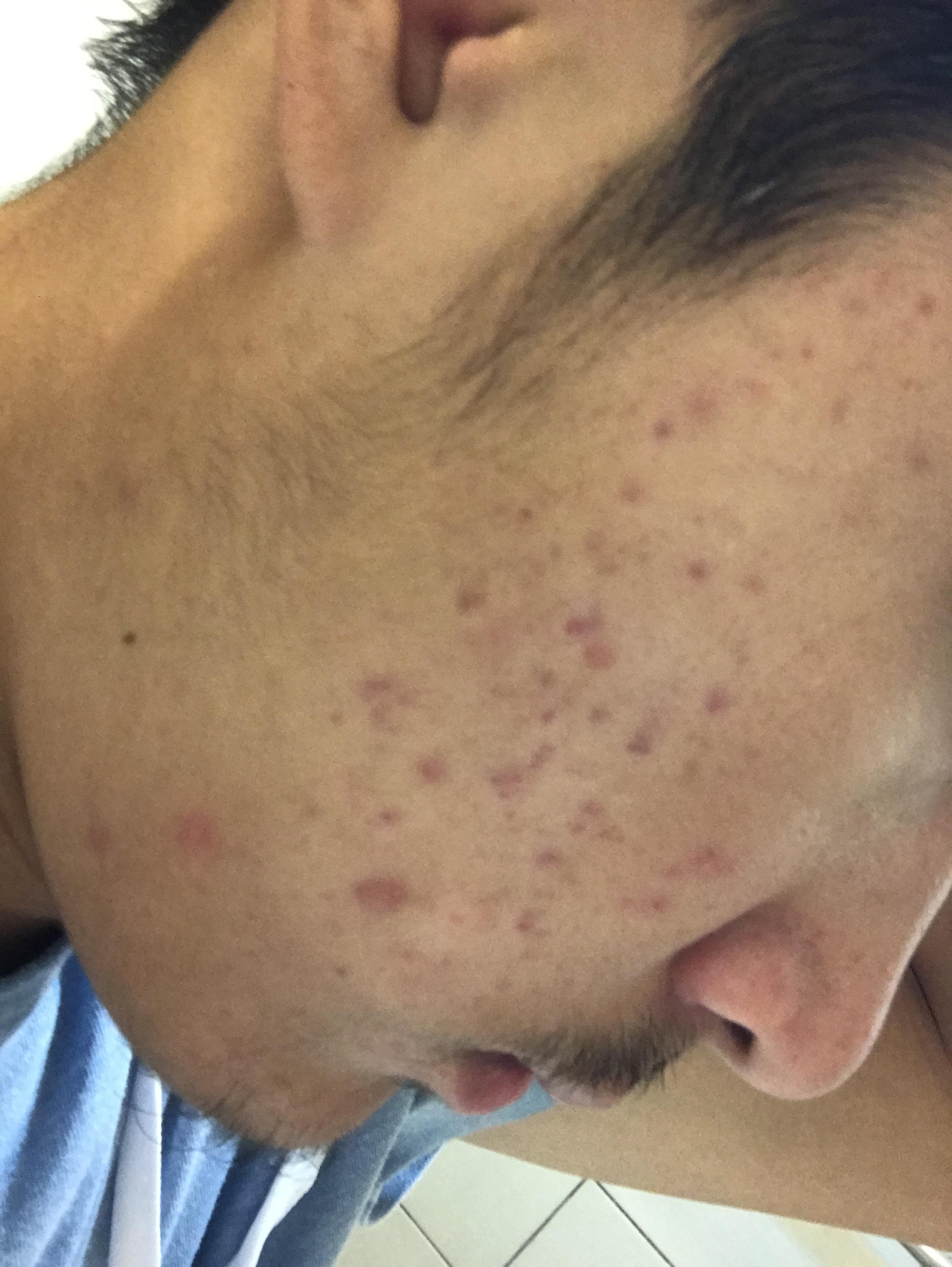 I have a lot of scars.Is there any hope for my acne scars
