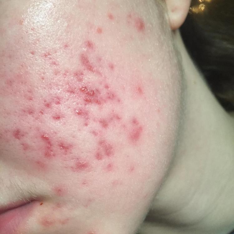 What can I do to treat these scars? Scar treatments