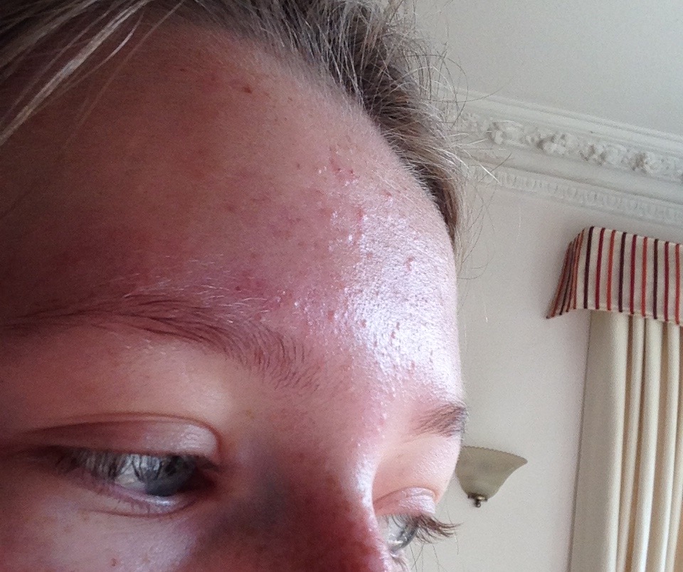 Mild to moderate forehead acne General acne discussion