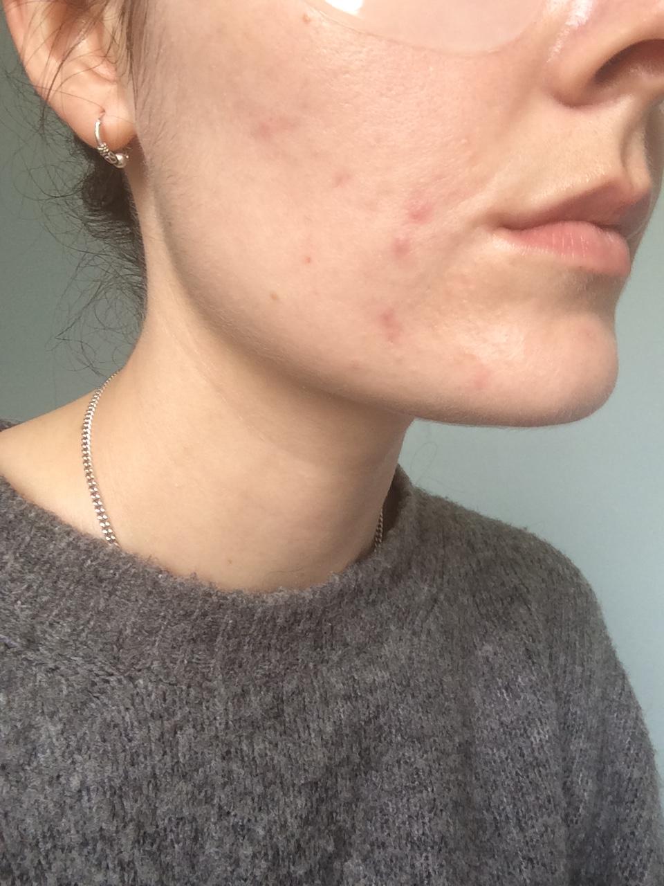 How can I get rid of under skin spots (pictures) Hormonal acne