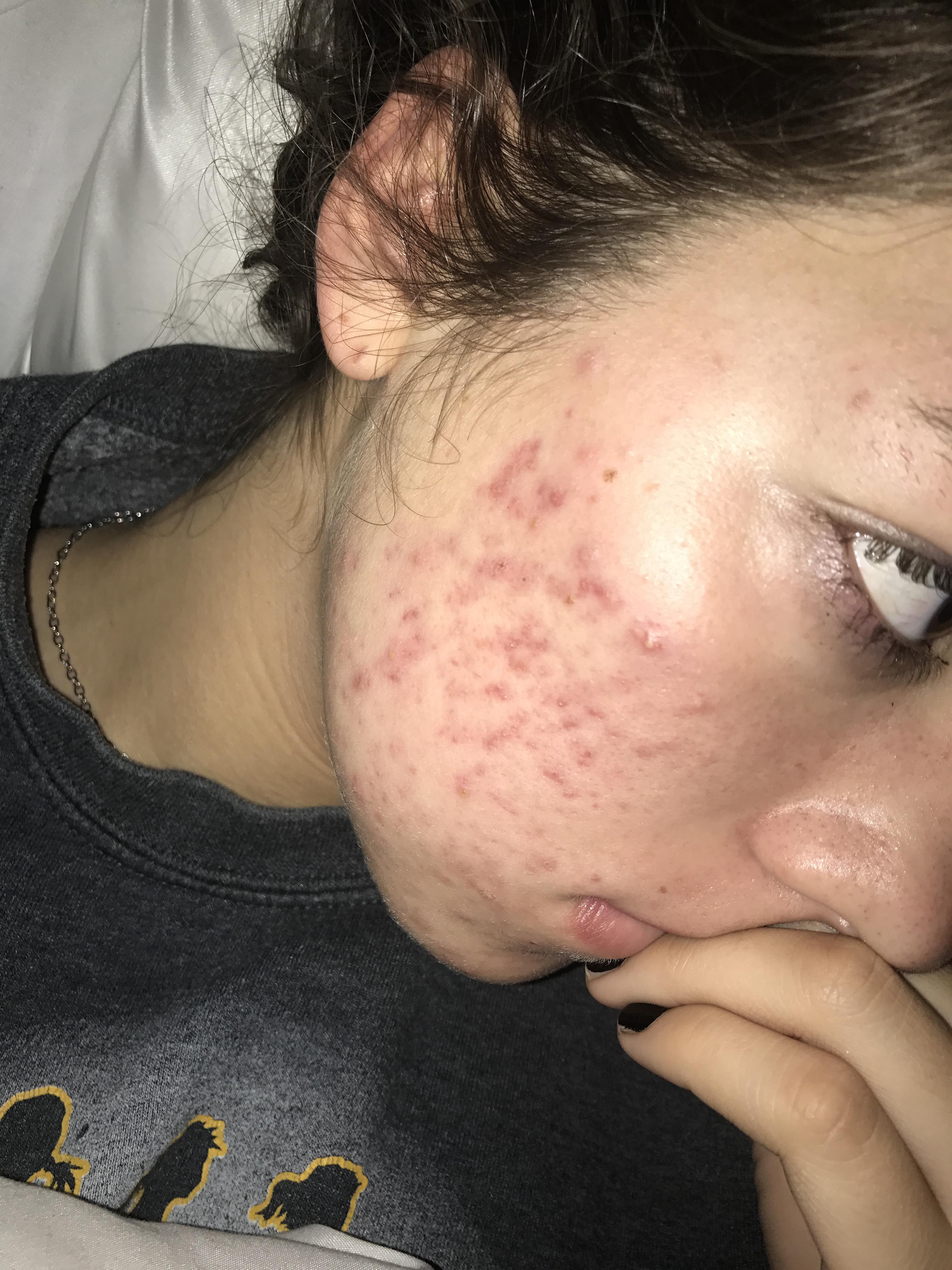 Help!! My red marks wont go away!! Hyperpigmentation red/dark marks