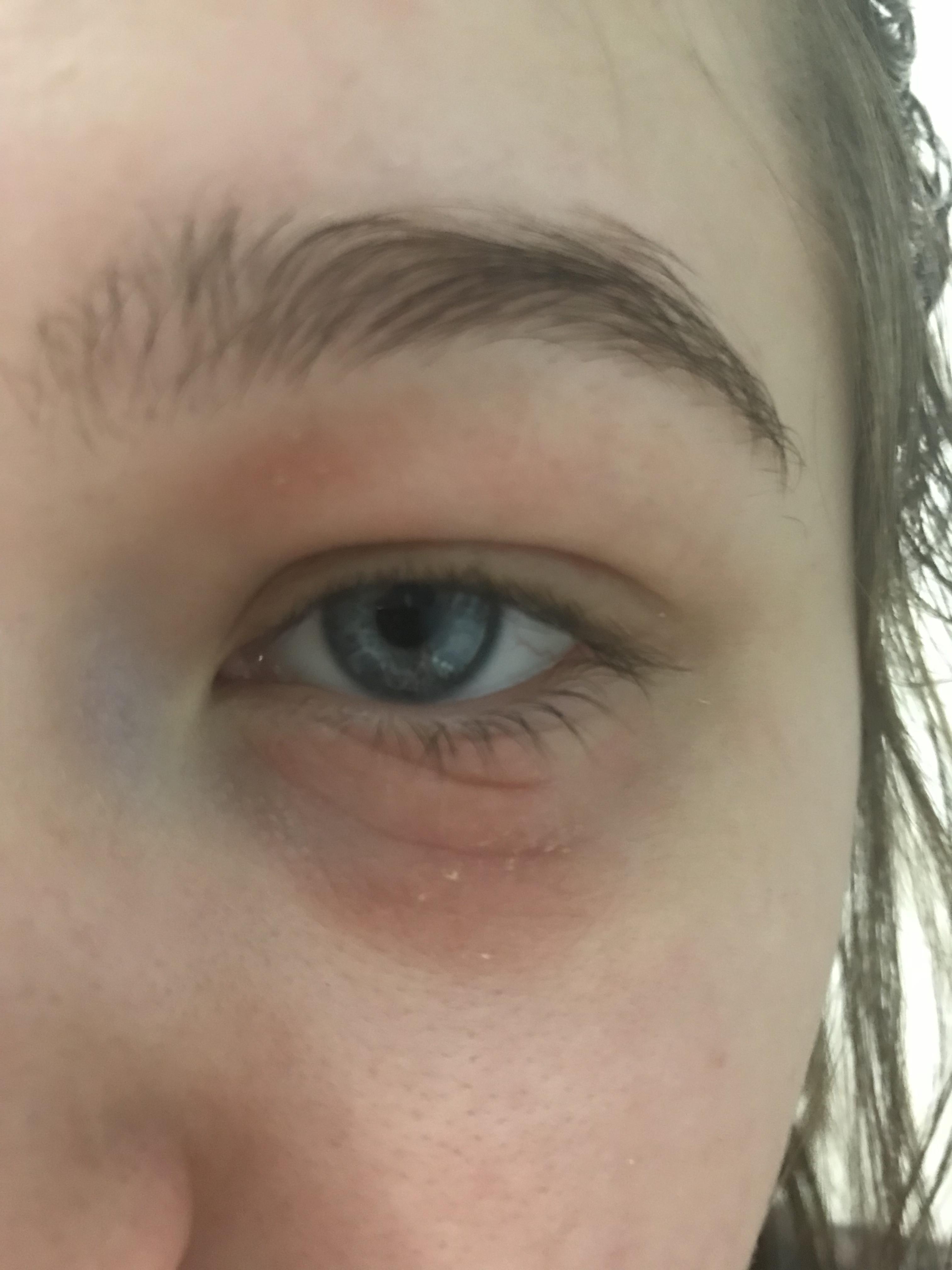 Both eyes red, swollen, itchy The Regimen Forum