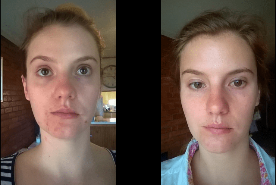 Azelaic acid clear after 10+yrs of acne Prescription acne