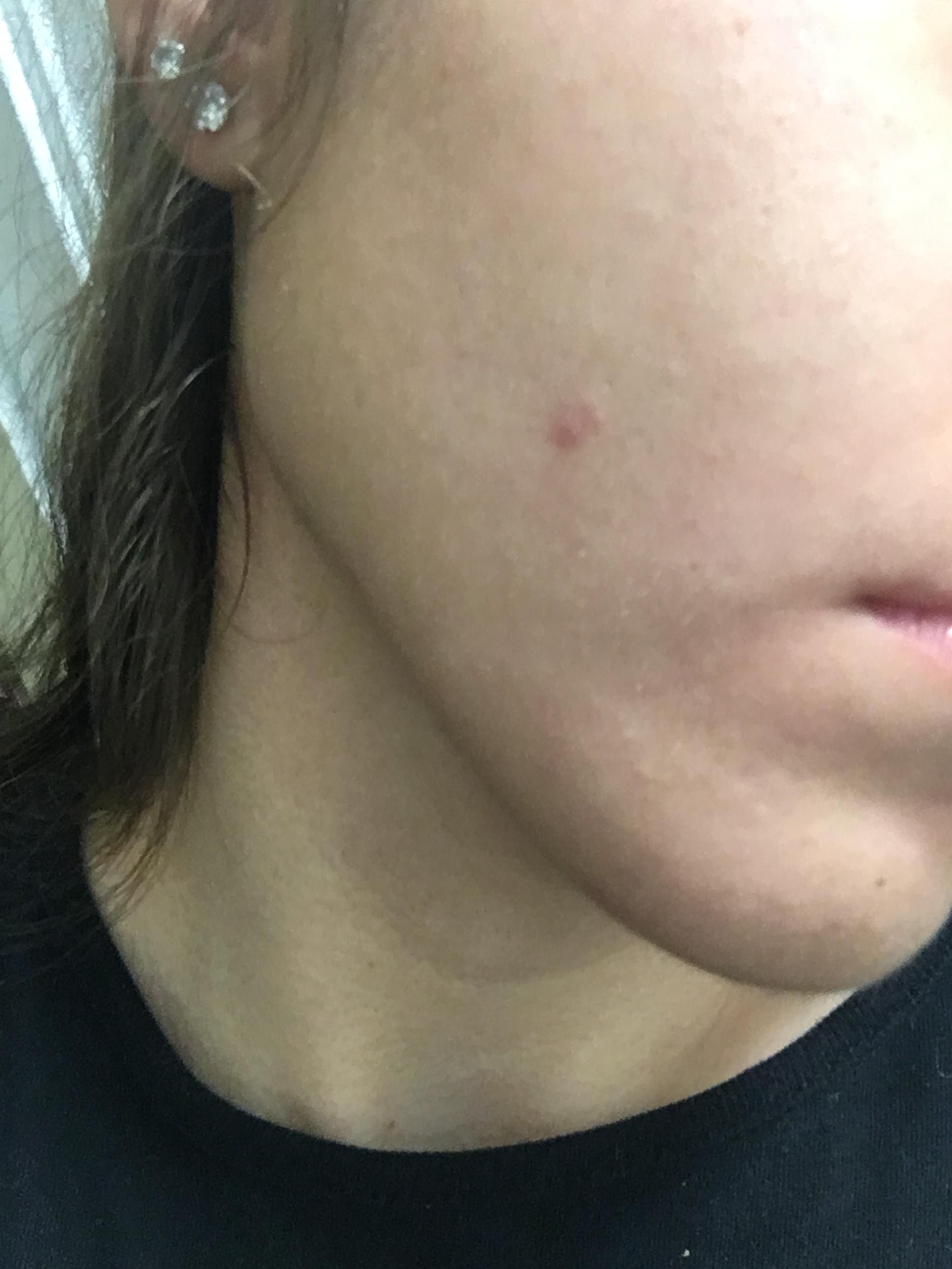 Red mark that wont go away. Hyperpigmentation red/dark marks