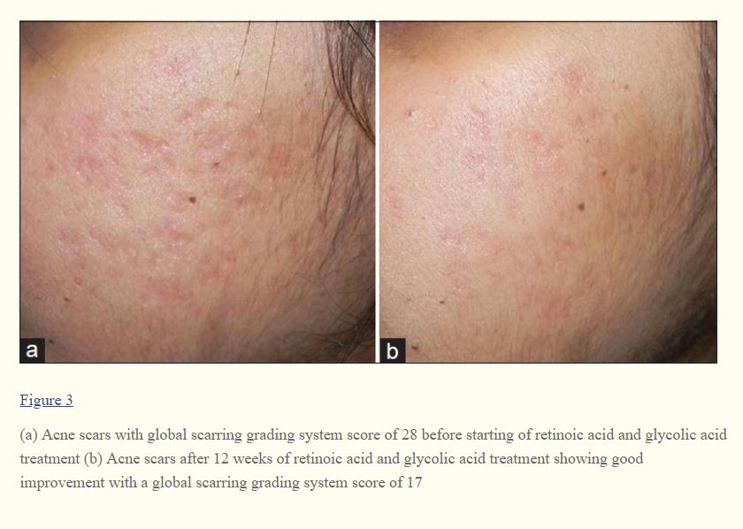 Study of Retinoic acid + glycolic acid topical on scar. Really good