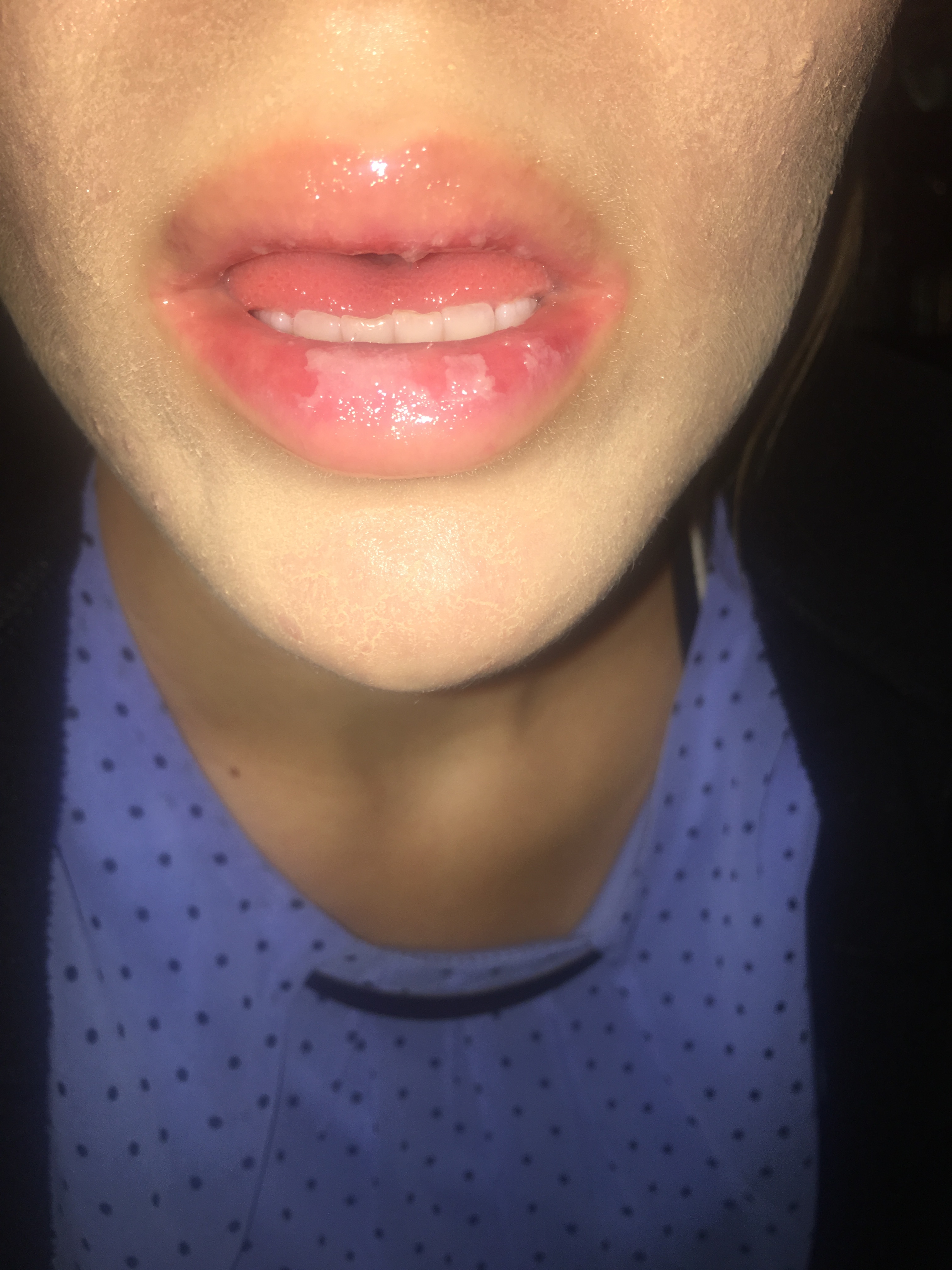 RAW RED LIPS PLEASE HELP Accutane (isotretinoin) logs Forum