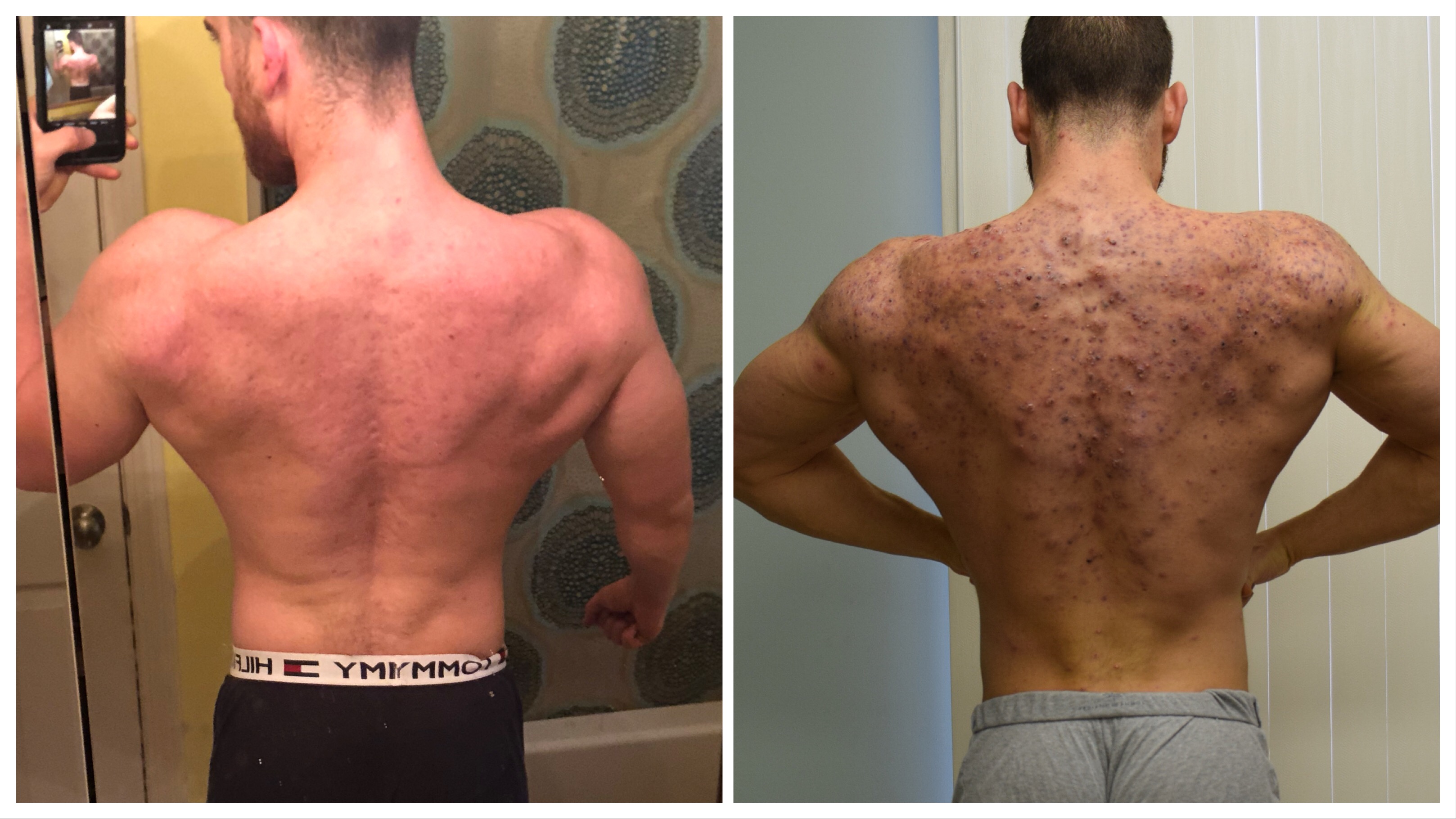 Back Acne Before And After Accutane