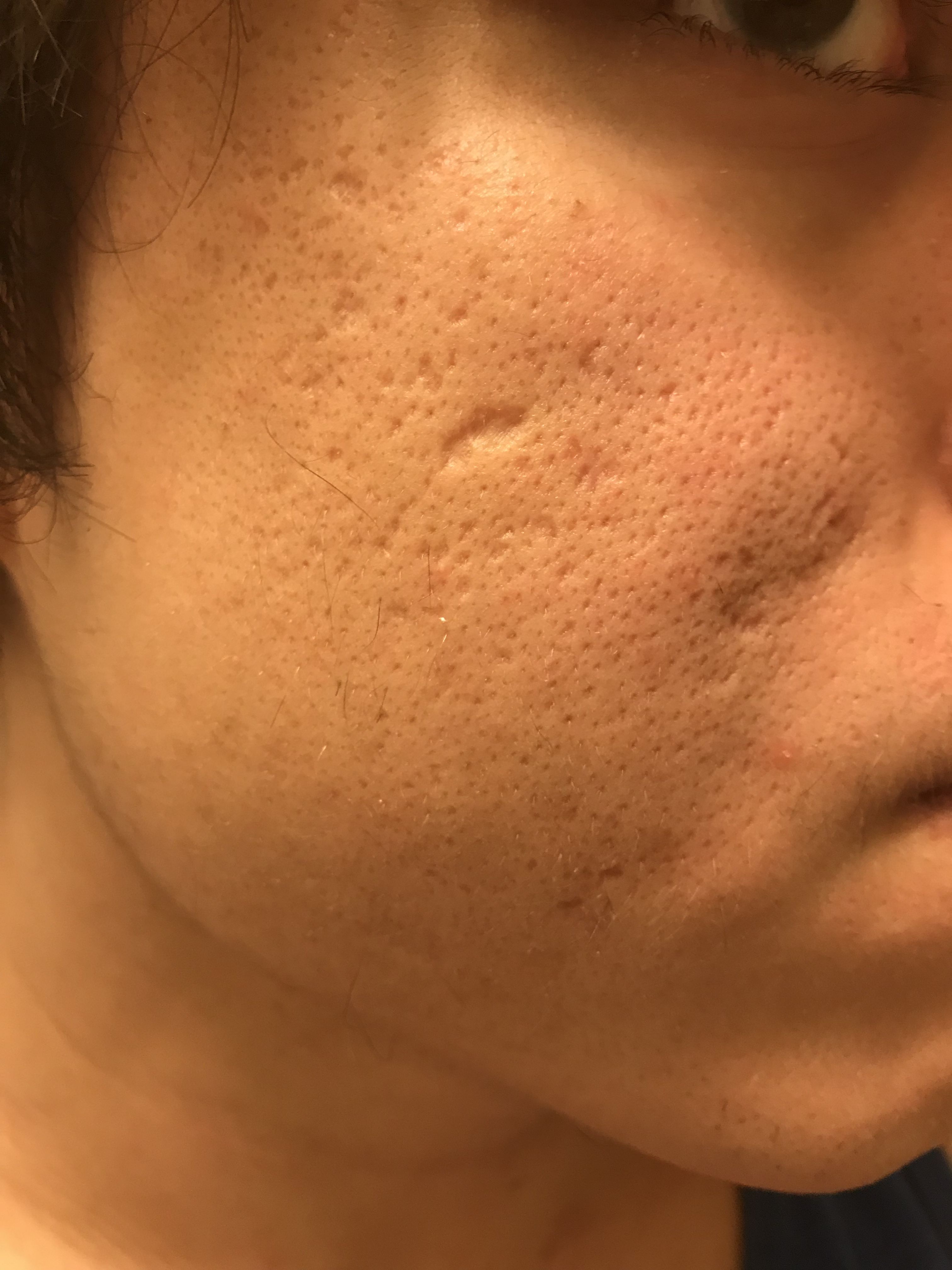 Excision/Acne Scar Literal Side By Side Comparison Scar treatments