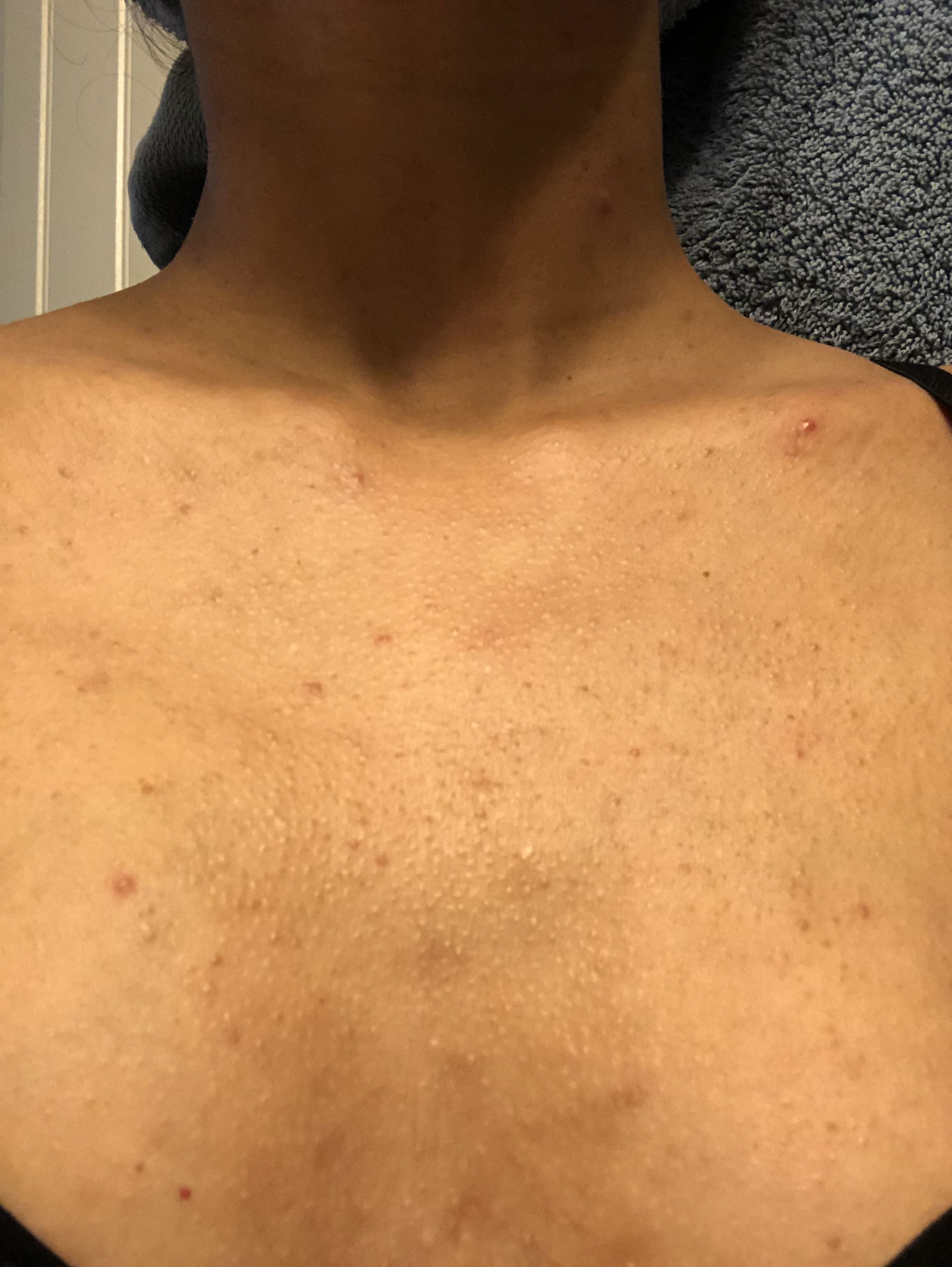 Web  twice per day, i have been washing my back. Web head and shoulders dandruff shampoo has helped me. Please help, my skin is flarring up like crazy Back/Body/Neck acne