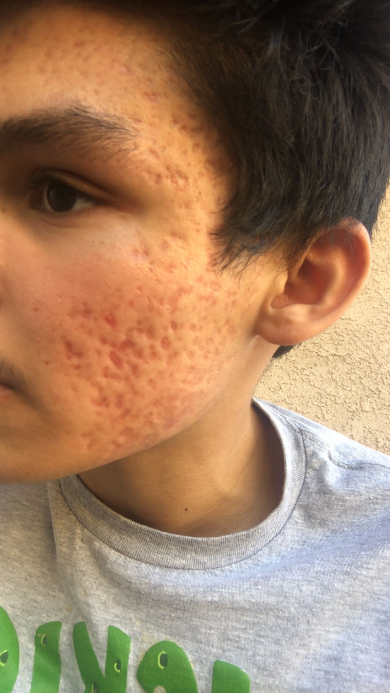 Severe acne scarring ( Scar treatments