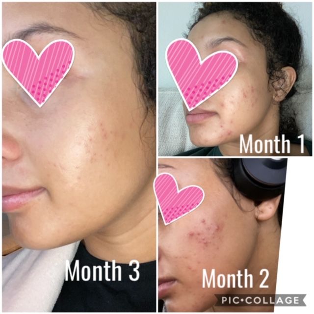 adapalene making acne worse Lillian Hart