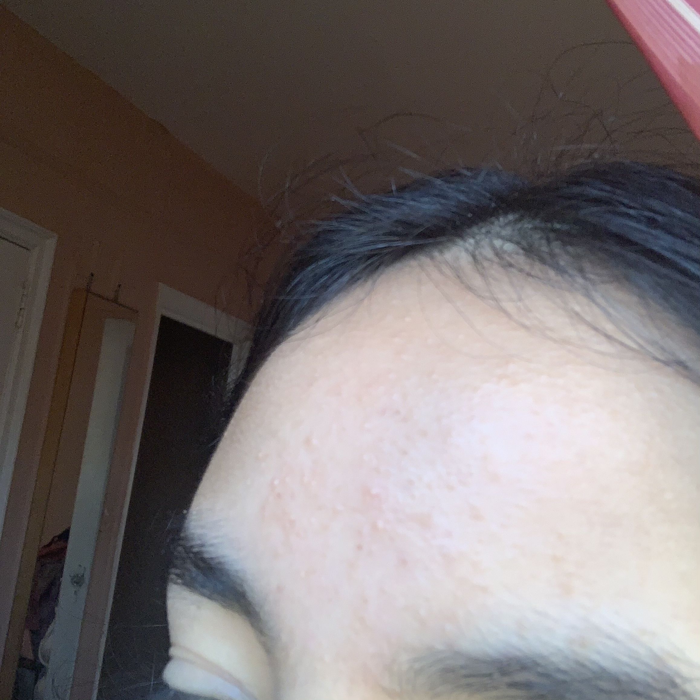 Forehead Bumps!!!! General acne discussion