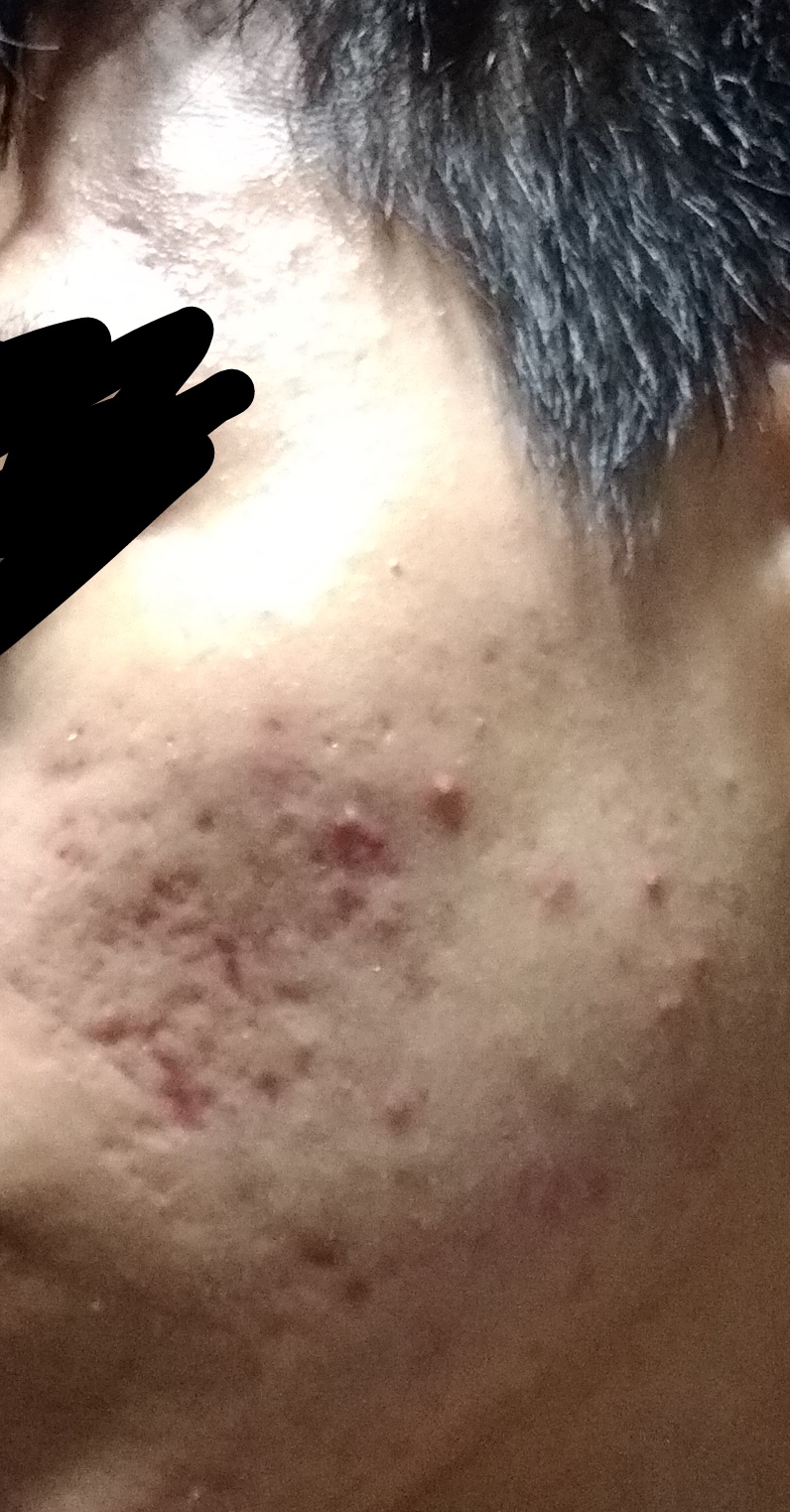 depressed acne scars Scar treatments Forum