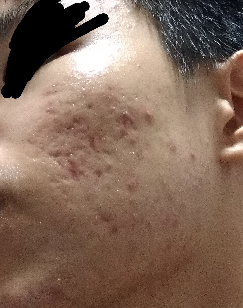 depressed acne scars Scar treatments Forum
