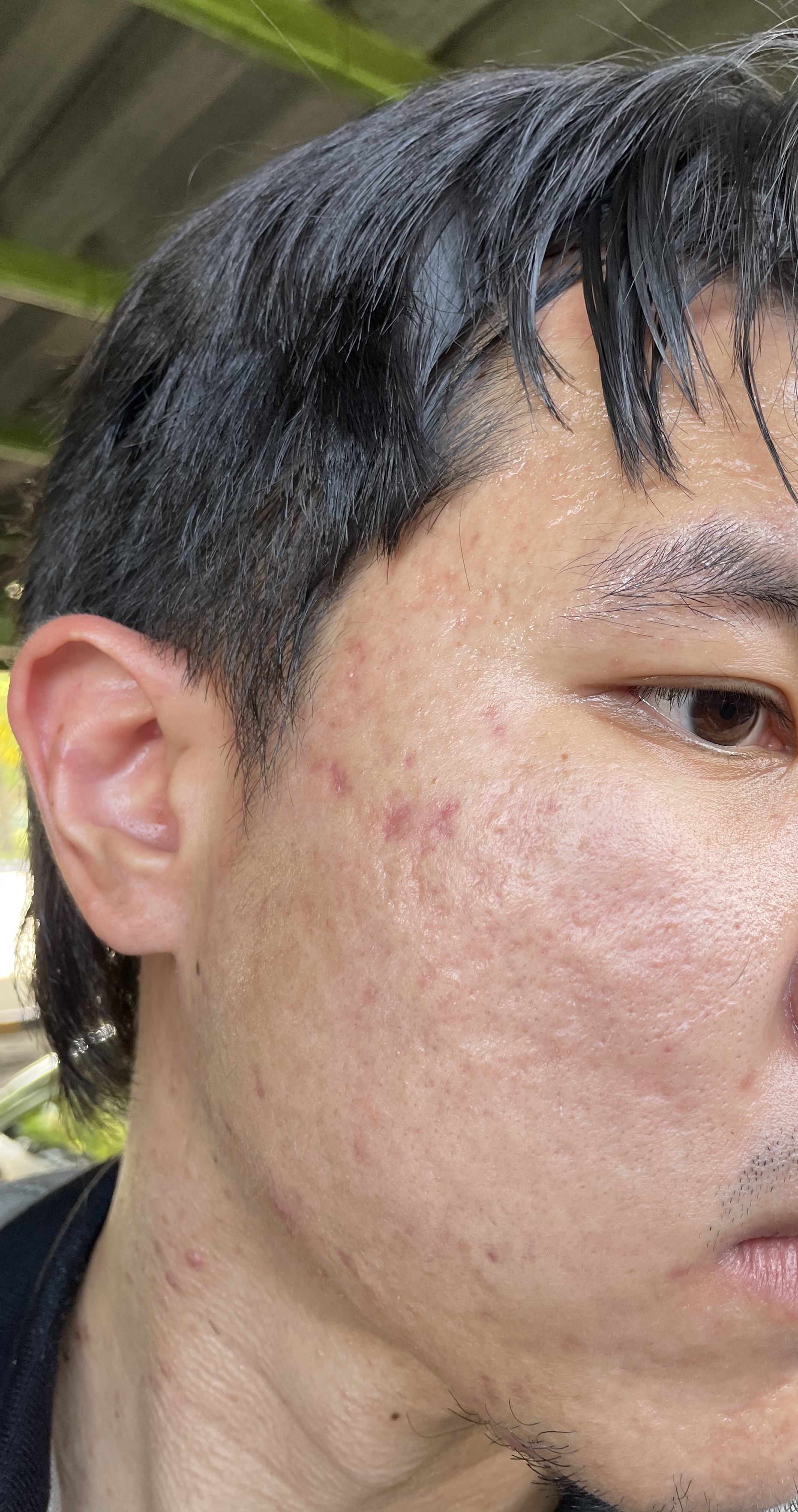 What is the best treatment for my severe acne scars after finishing or