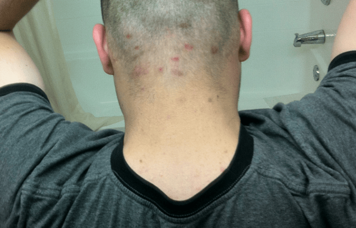 Scalp/neck Acne Adult acne Community