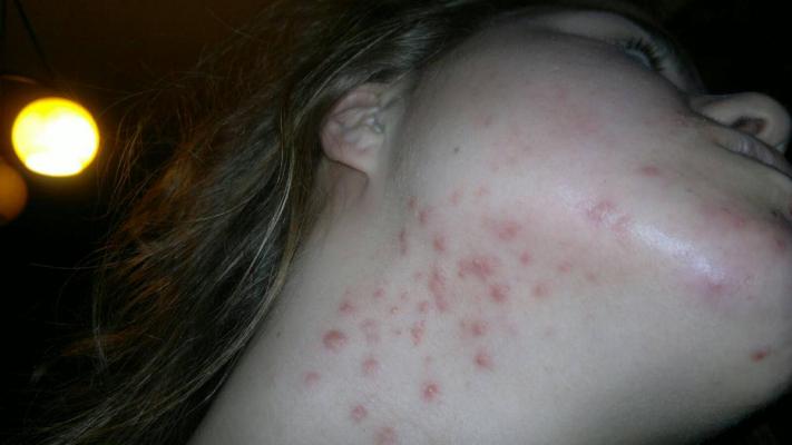 Very Bad Neck Acne, What Products Should I Use? Back