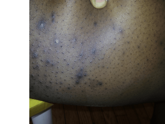 Acne Between My Inner Thighs Back/Body/Neck acne Community