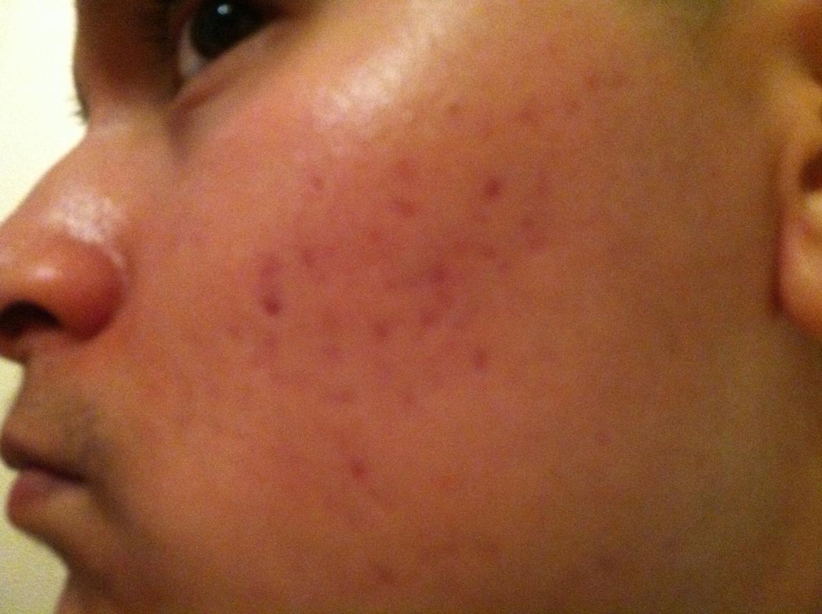 Red Marks/scars On My Cheeks Left After Acne (Pics Included