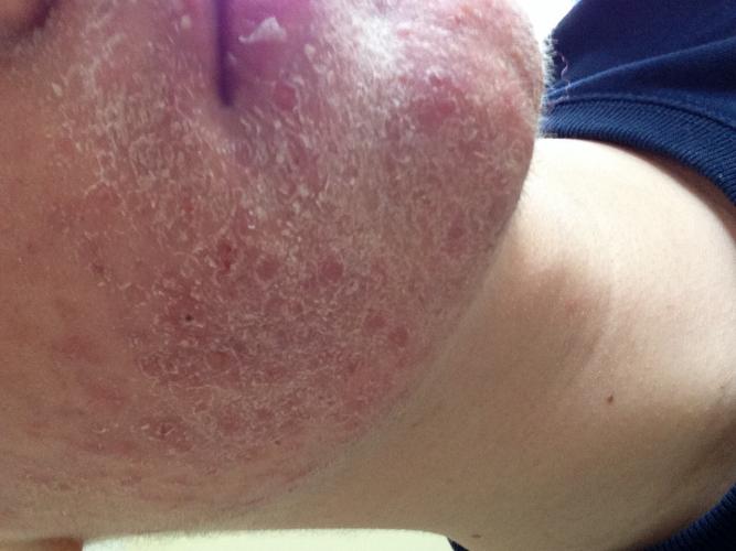 Josh's Roaccutane Log Accutane (isotretinoin) logs by