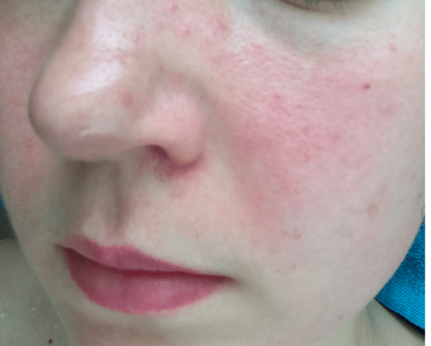 Is There Any Solution To This? Large Pores, Scarring, Orange Peel