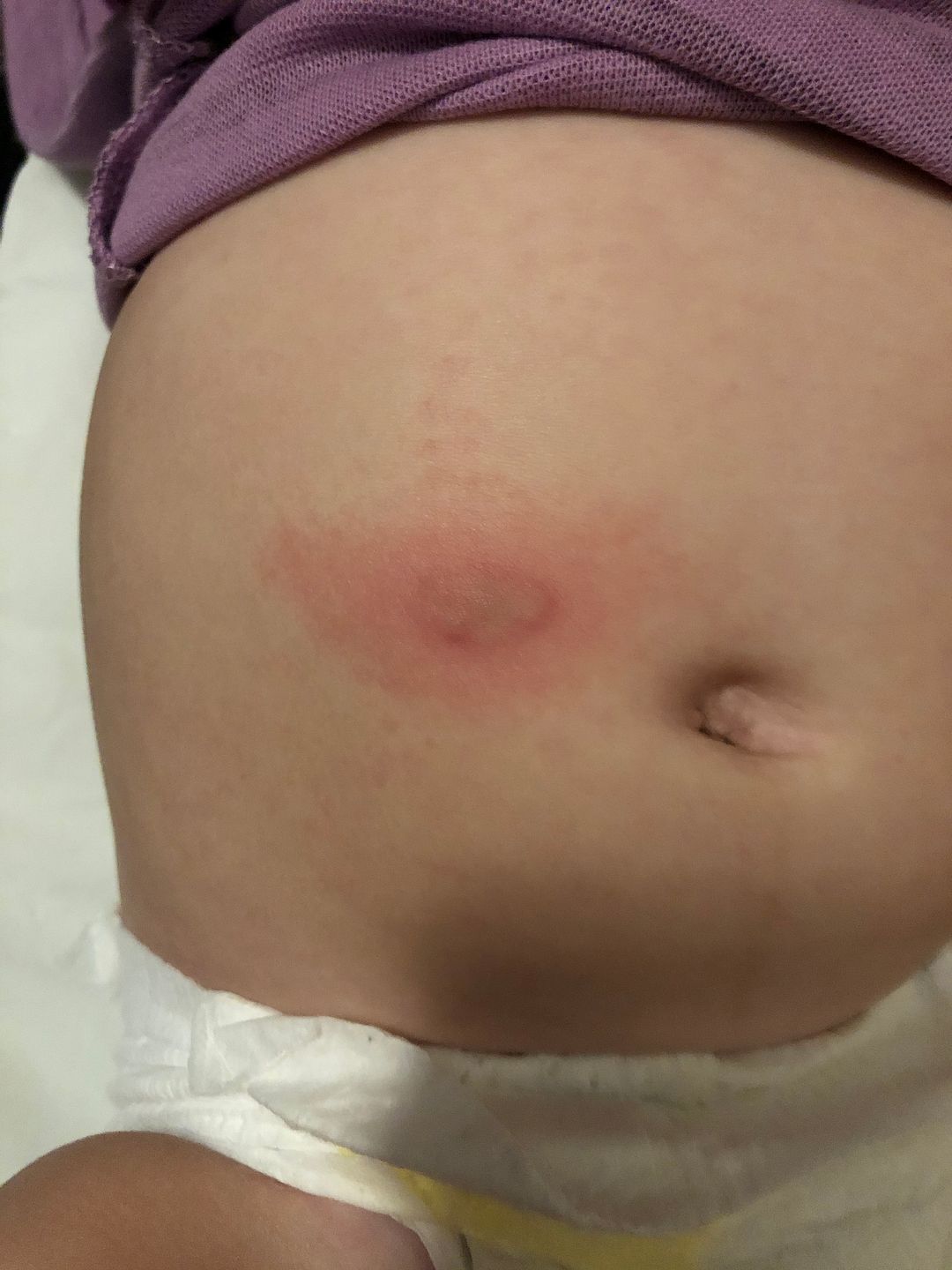 Small blister on stomach BabyCenter