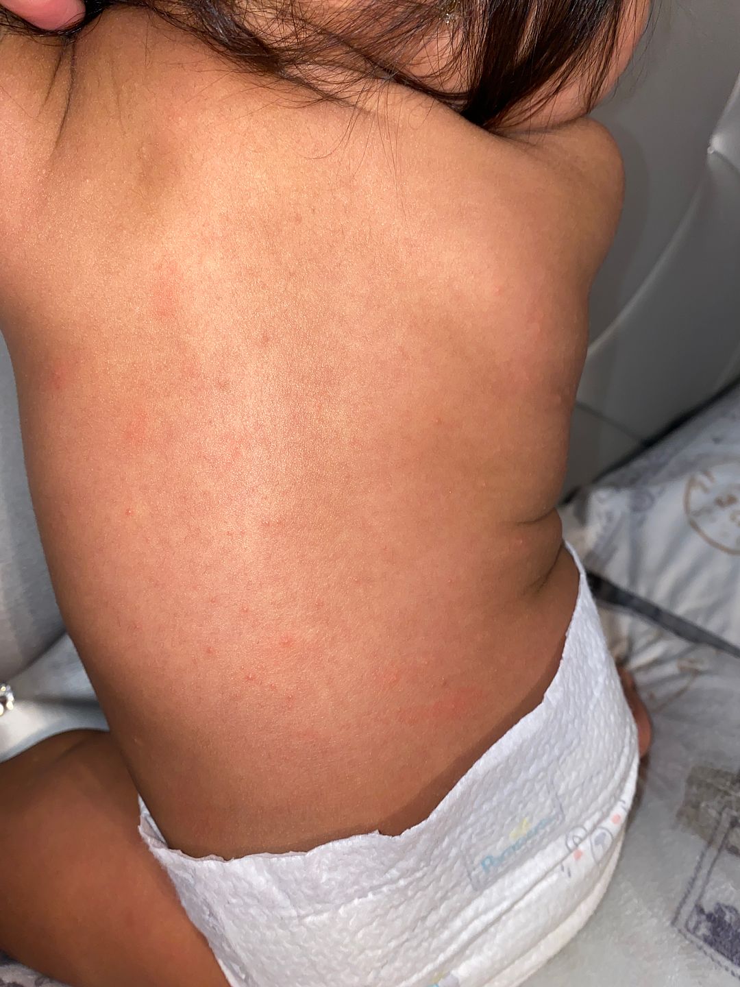 What kind of rash is this? BabyCenter
