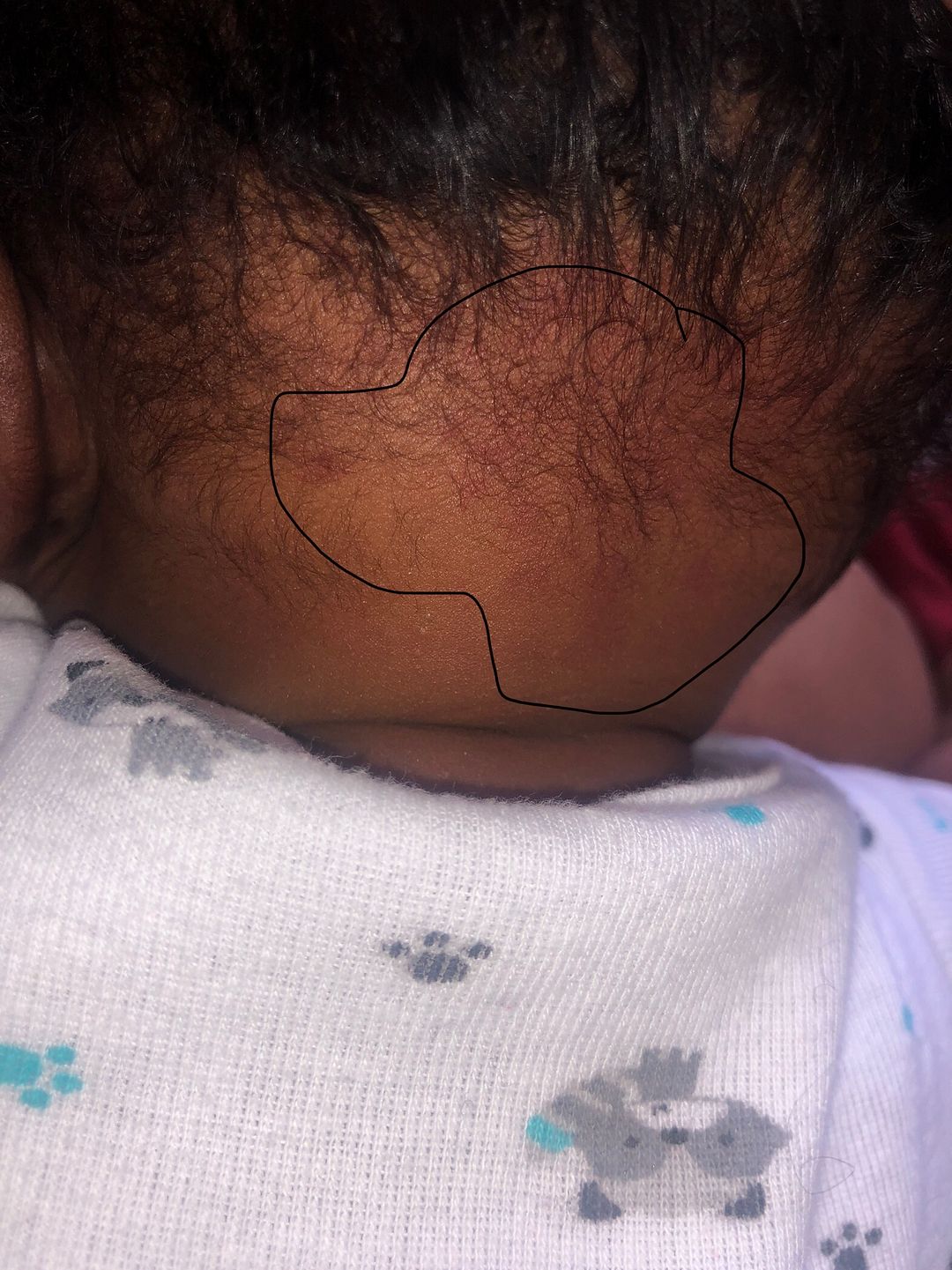 Baby rash BabyCenter