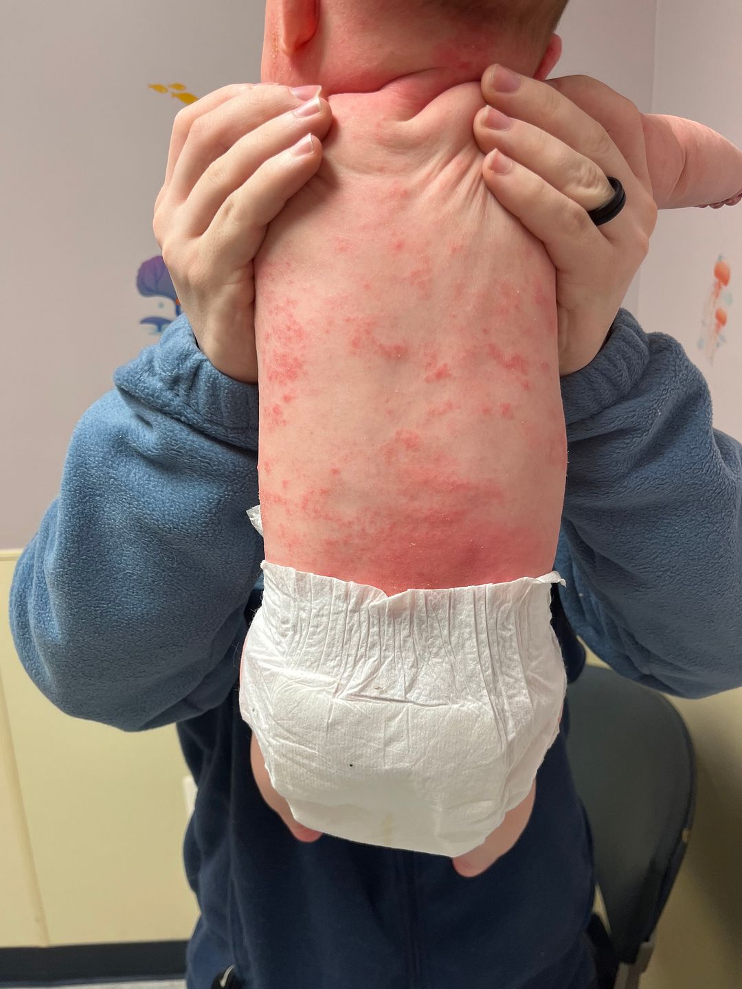 Bad eczema BabyCenter
