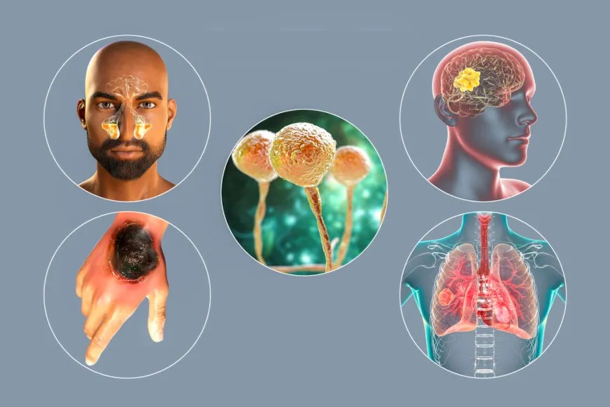 Mucormicose o que é, causas, sintomas, transmissão Biologia Net