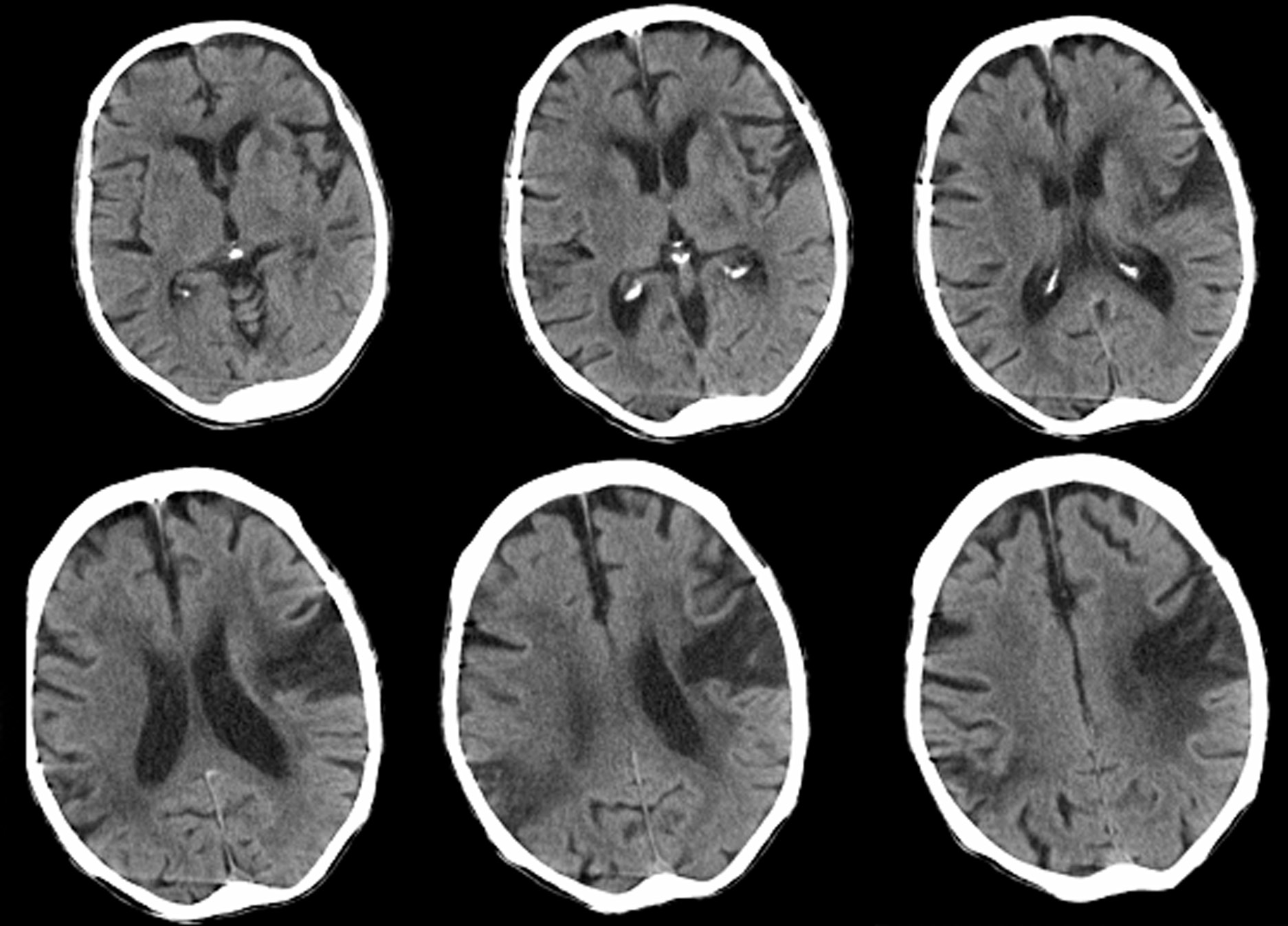 What Does Dementia Look Like On A Ct Scan ct scan machine