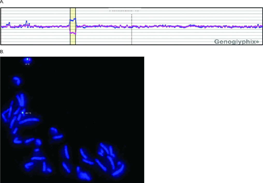 CHROMOSOMAL MICROARRAYS THE BENEFITS AND CHALLENGES OF INTRODUCTION INTO PRENATAL DIAGNOSIS