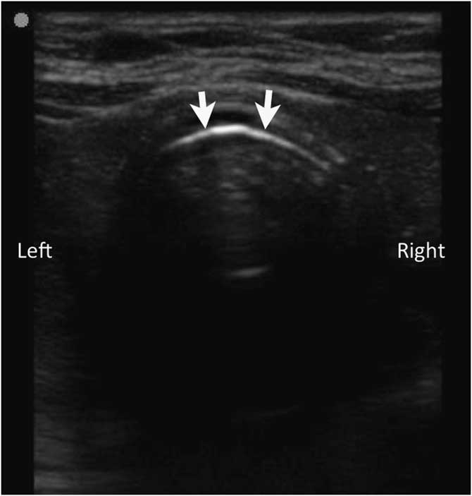 Avoid the Goose! Paramedic Identification of Esophageal Intubation by