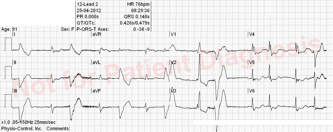 ECG Interpretation 1 ECG Quiz