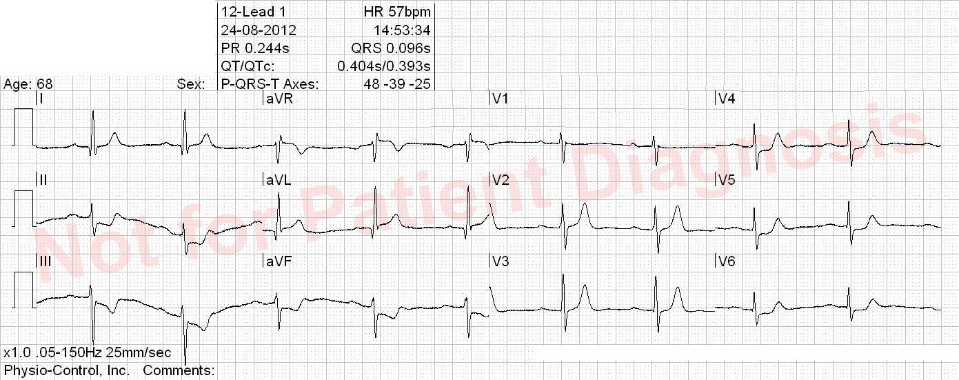 ECG Interpretation 1 ECG Quiz