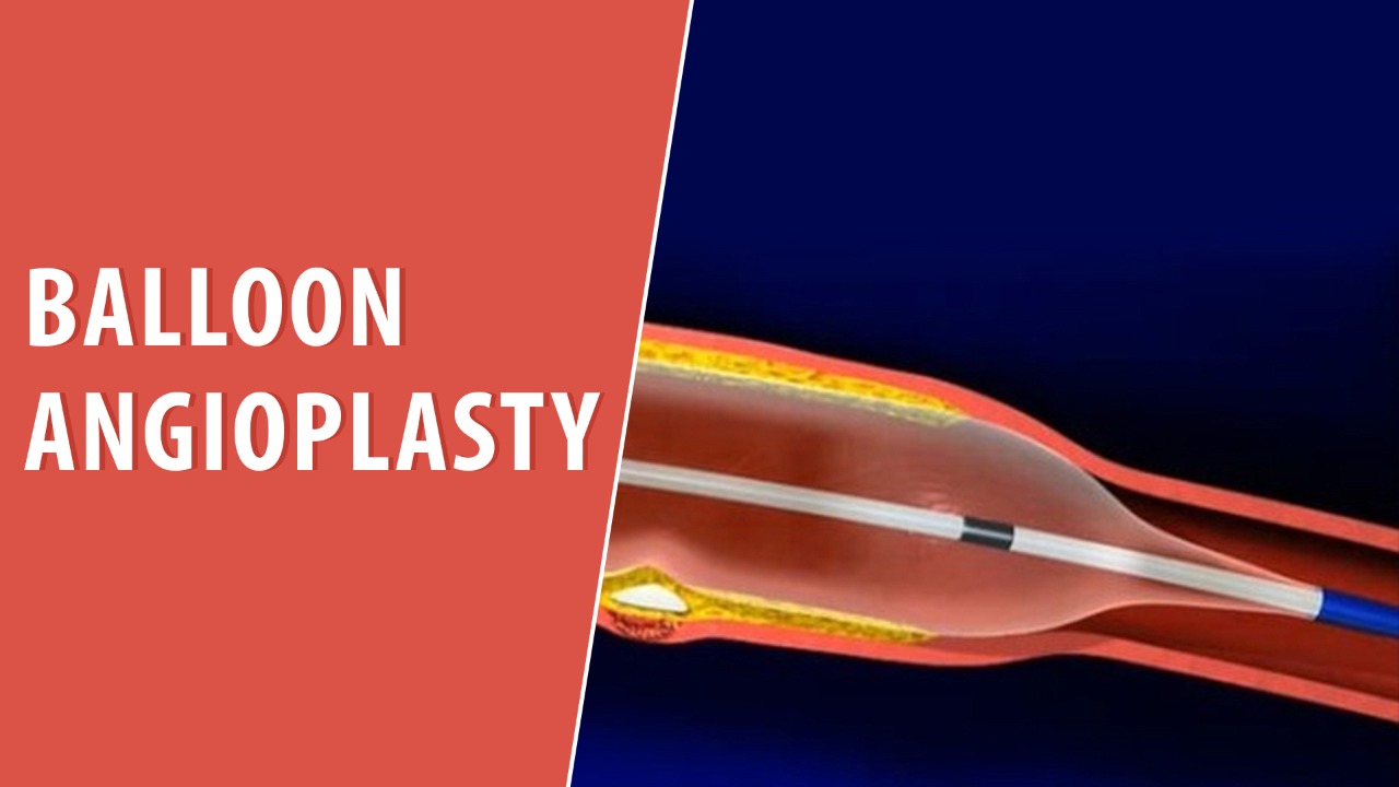 Balloon angioplasty Cardiac Rehab Trusted Patient Education Platform