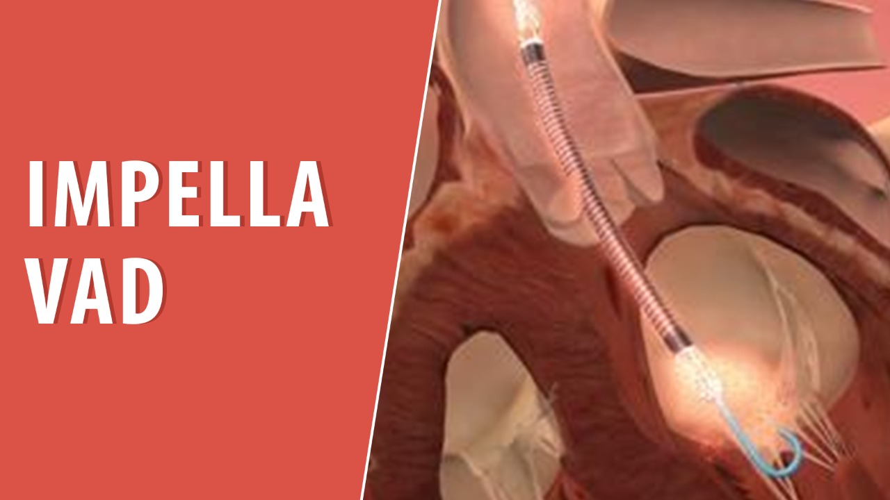 Impella Heart Pump CardioVisual Trusted Patient Education Platform