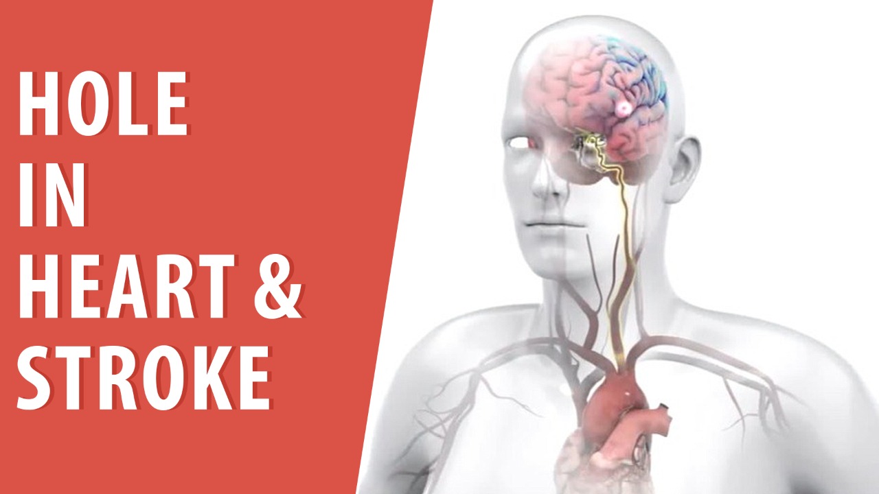 Hole in Heart & Stroke CardioVisual Trusted Patient Education Platform