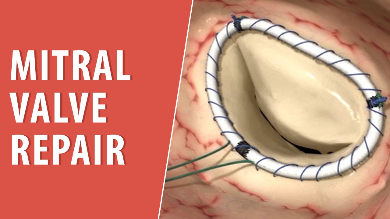 Ways to repair mitral valve