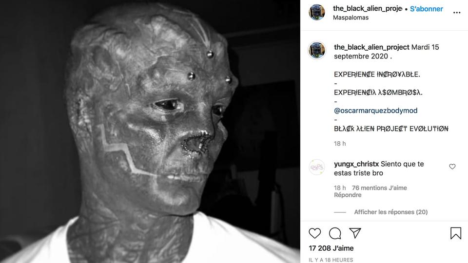 Après les oreilles, le Montpelliérain « Black Alien » se fait retirer