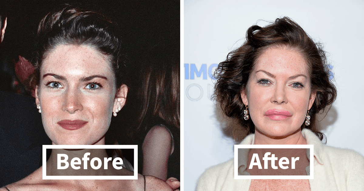 15 Plastic Surgeries That Disfigured A Celeb’s Face DeMilked