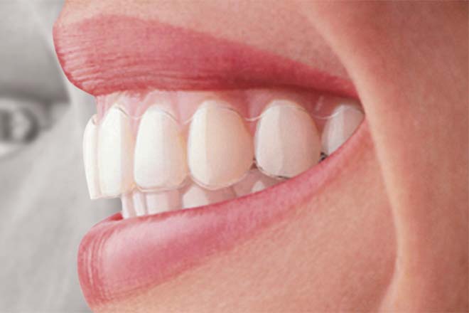 Braces vs Invisalign Difference and Comparison Diffen