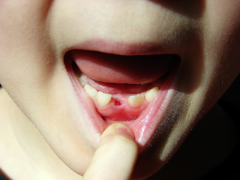 Milk Tooth - Definition And Synonyms Of Milk Tooth In The English Dictionary