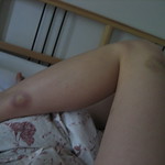 bruises