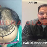 Hair transplant result