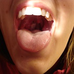 Please note the displaced uvula (hangy ball) in this picture secondary to the large, disgusting tonsil on the right.