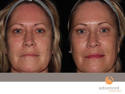 Fractional co2 laser skin resurfacing cost, how to back acne treatment